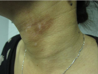 “细胞复色”疗法的疗效特征