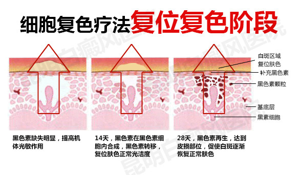 “细胞复色”疗法的治疗原理