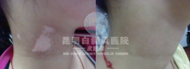 详细为您介绍白癜风的危害有哪些