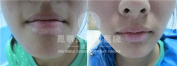 青少年白癜风危害