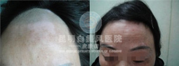 白癜风是怎样引起的