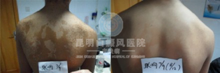 白癜风患者如何补充营养