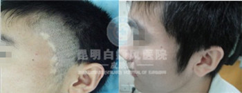 白癜风如何治疗有效果呢?