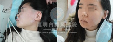 白癜风(白斑病)患者的饮食需要吃什么