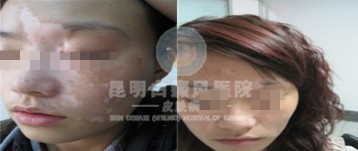 面部白癜风的危害有哪些