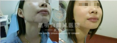 早期面部白癜风的三个特征是什么?