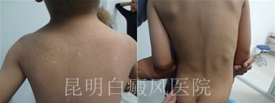 背部白癜风的病因