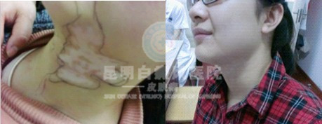 导致颈部白癜风的病因有哪些