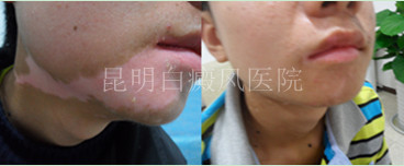 颈部产生白癜风的原因