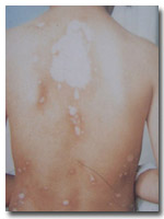 背部白癜风如何治疗效果好