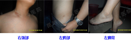 2年的白癜风在我院3个月治好