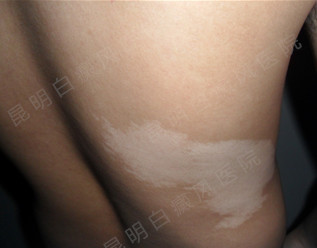 如何防止背部白癜风扩散