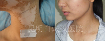 女性颈部白癜风要注意什么