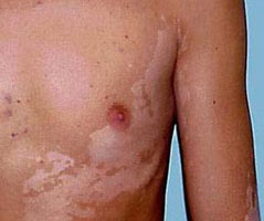 胸部白癜风扩散的原因有哪些?