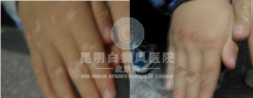 手部白癜风的危害性有多大?