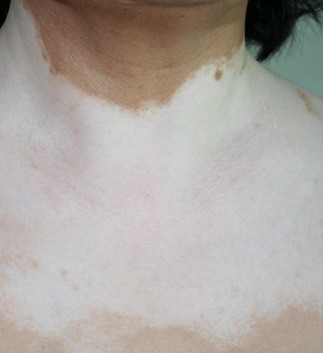 胸部白癜风该如何进行预防呢?