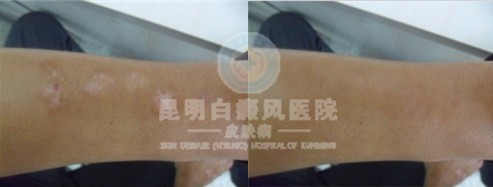 手臂白癜风有哪些早期症状表现?
