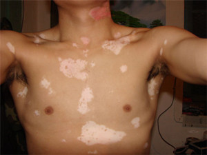 胸部白癜风有什么样的危害