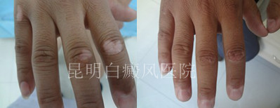 手上有白癜风要注意哪些问题