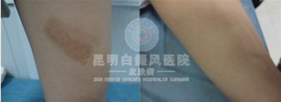 脚部白癜风扩散的原因