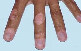 手部为什么易患白癜风
