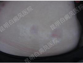 26岁女性腹部患白癜风3年