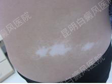 26岁女性腹部患白癜风3年