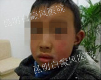 儿童/局限型/唇部左侧白斑