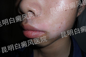 男性左侧脸部局限型白癜风1年