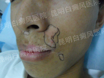 轻松挥别白癜风 还我俊俏脸庞