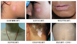 白癜风有哪些自我诊断的方法?