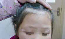 儿童白癜风的发病原因有哪些?