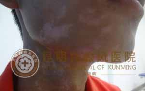 青少年白癜风(白斑)能治好吗?