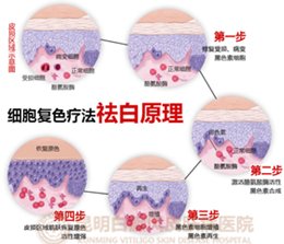 医学界公认为第四大白癜风治疗技术——“细胞复色”祛白技术