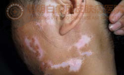 18岁女性面部患白癜风3年