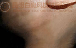 18岁女性面部患白癜风3年