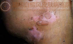 18岁女性面部患白癜风3年