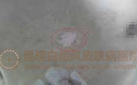 胸部白斑八个月,在我院成功治愈