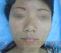 面部白斑三年,在我院成功治愈