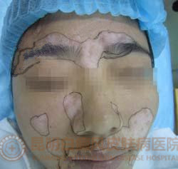 面部白斑三年,在我院成功治愈