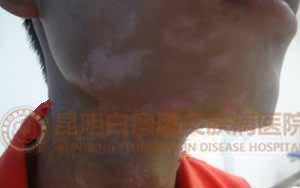 下巴周围大片白斑,在我院成功治愈