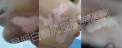 身上长白斑怎么回事,是什么病?怎么治?