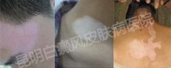 身上长白斑怎么回事,是什么病?怎么治?