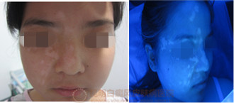 18岁女孩面部白斑,在我院康复