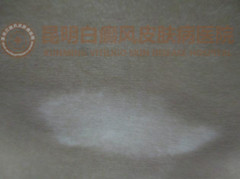 腰部白斑2年余,在我院成功治愈