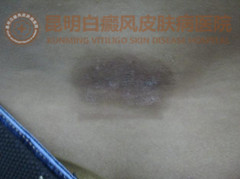 腰部白斑2年余,在我院成功治愈