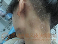 17岁女孩多块白斑,在我院成功治愈