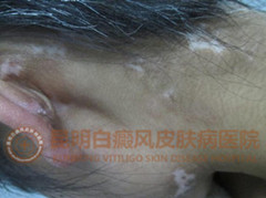 17岁女孩多块白斑,在我院成功治愈