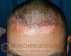 额头白癜风,在我院成功治愈