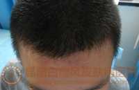 额头白癜风,在我院成功治愈